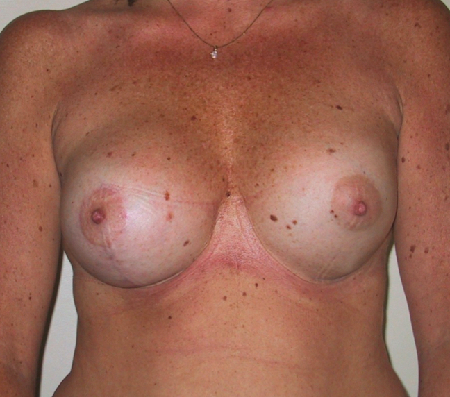 Breast Asymmetry After Result 3