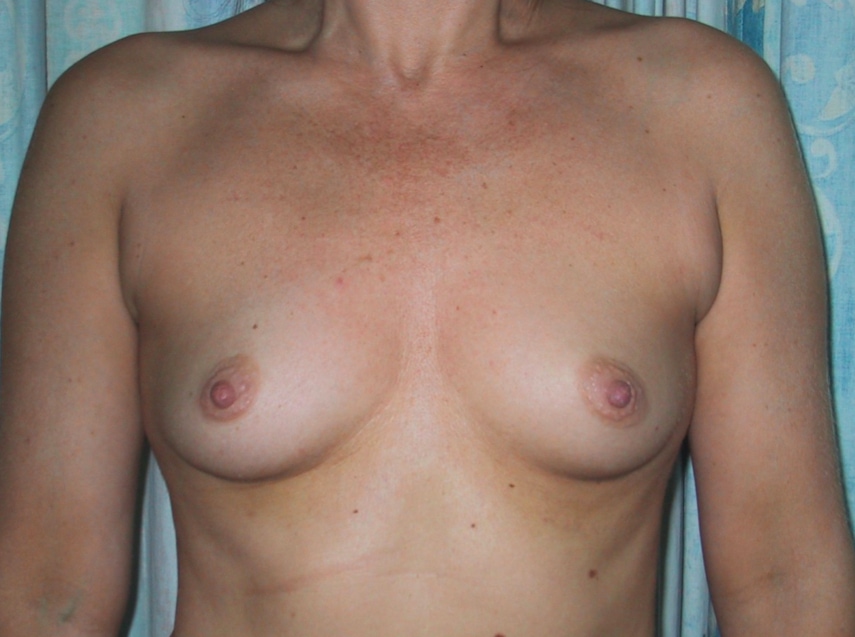 Breast Augmentation Before Result 2
