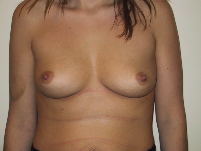 Breast Augmentation Before Result 3