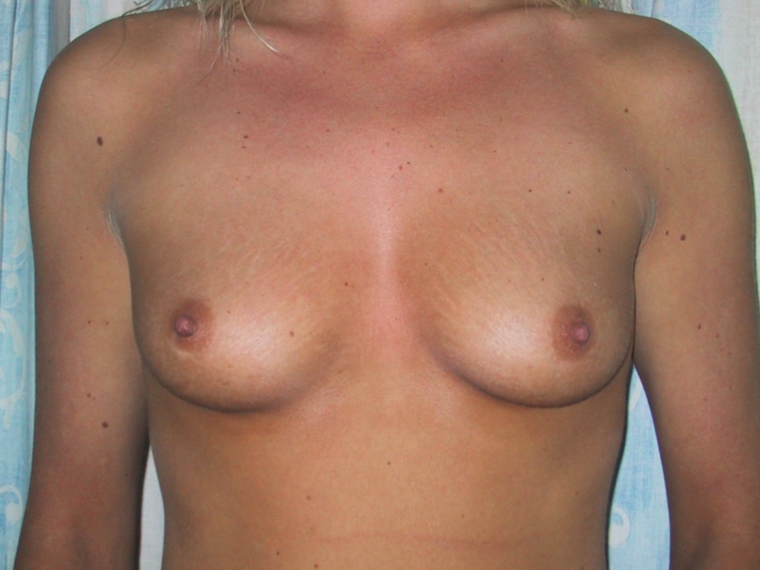 Breast Augmentation Before Result 5