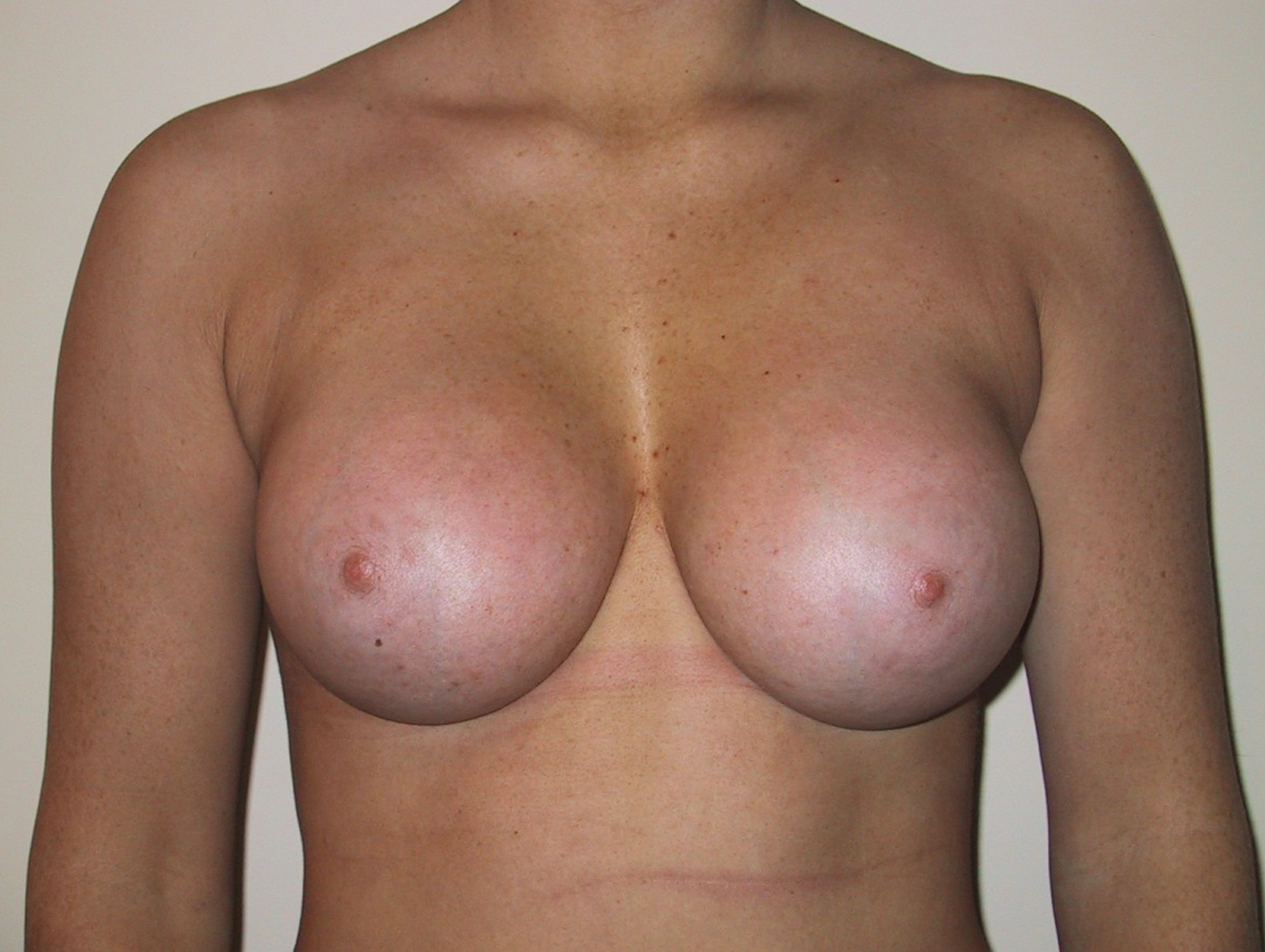 Breast Augmentation After Result 6