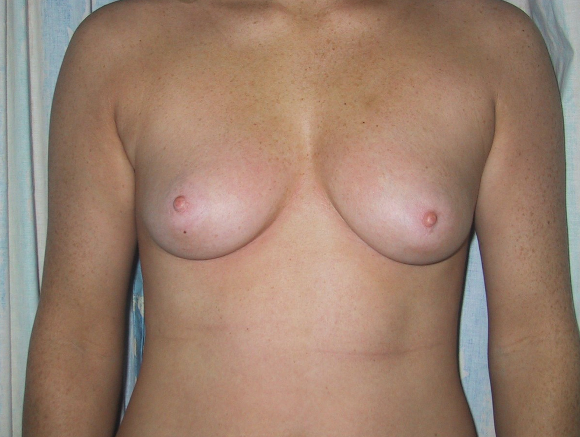 Breast Augmentation Before Result 6