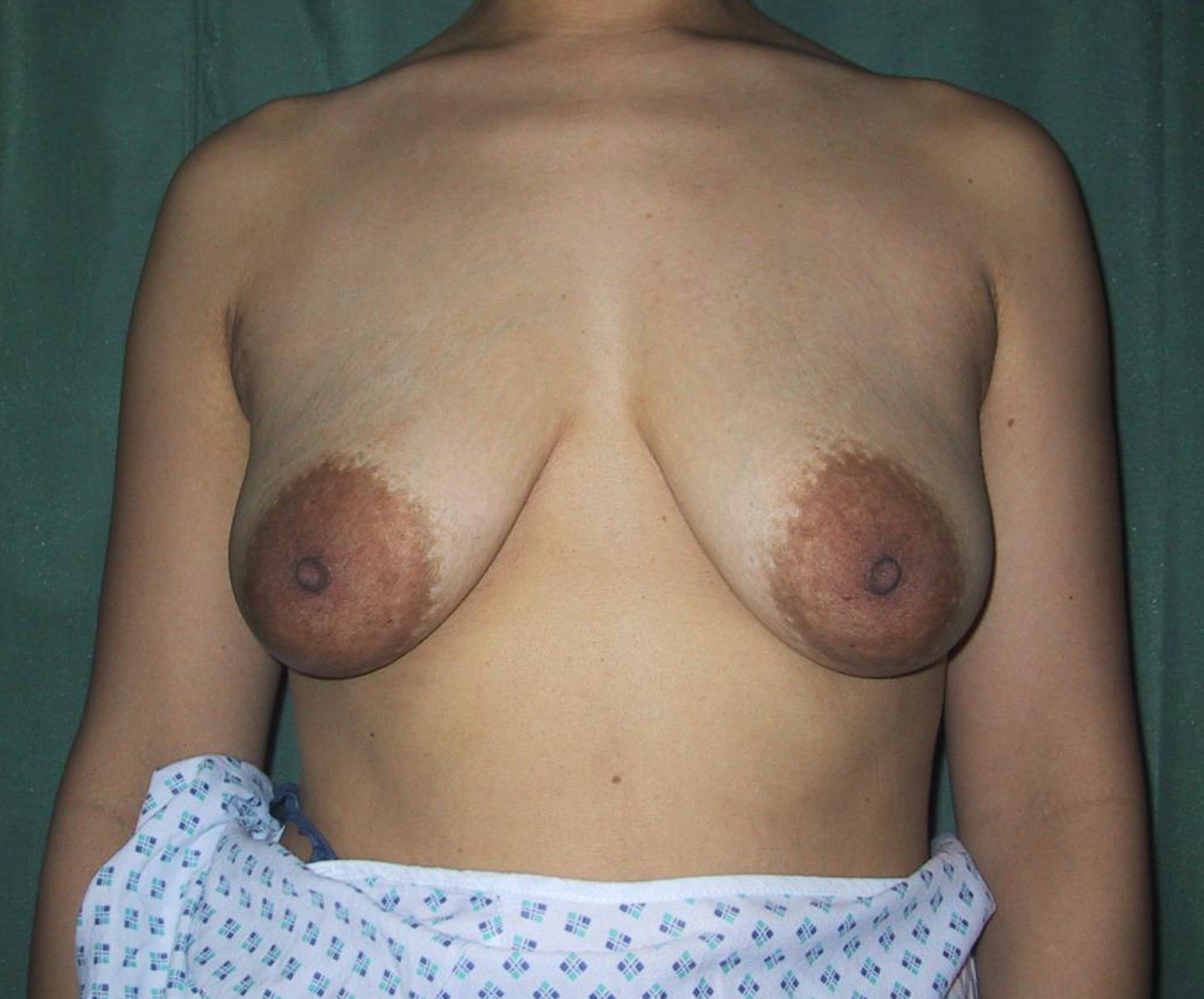 Breast Lift Before Result 10