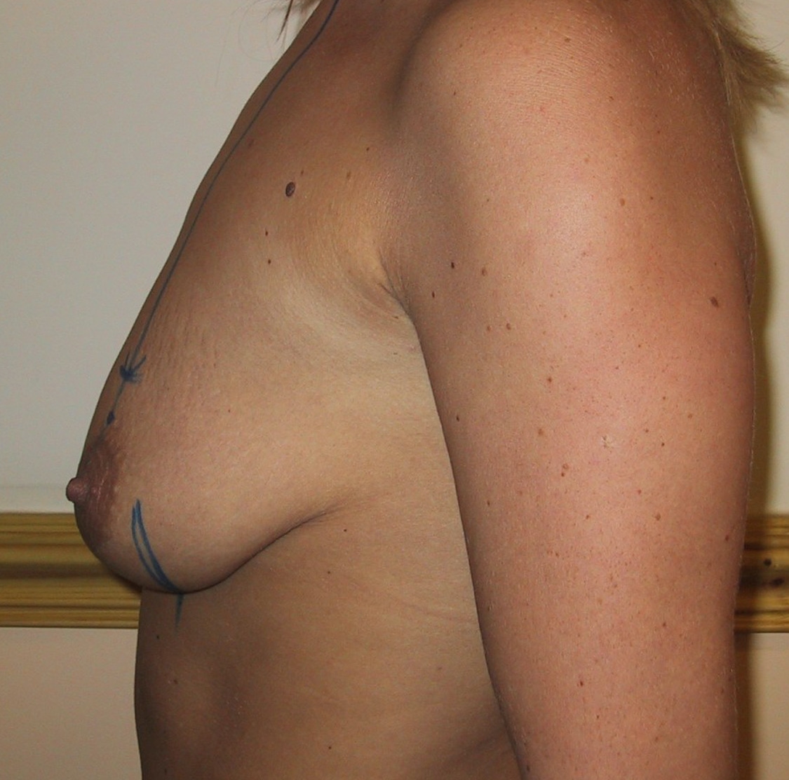 Breast Lift Before Result 12