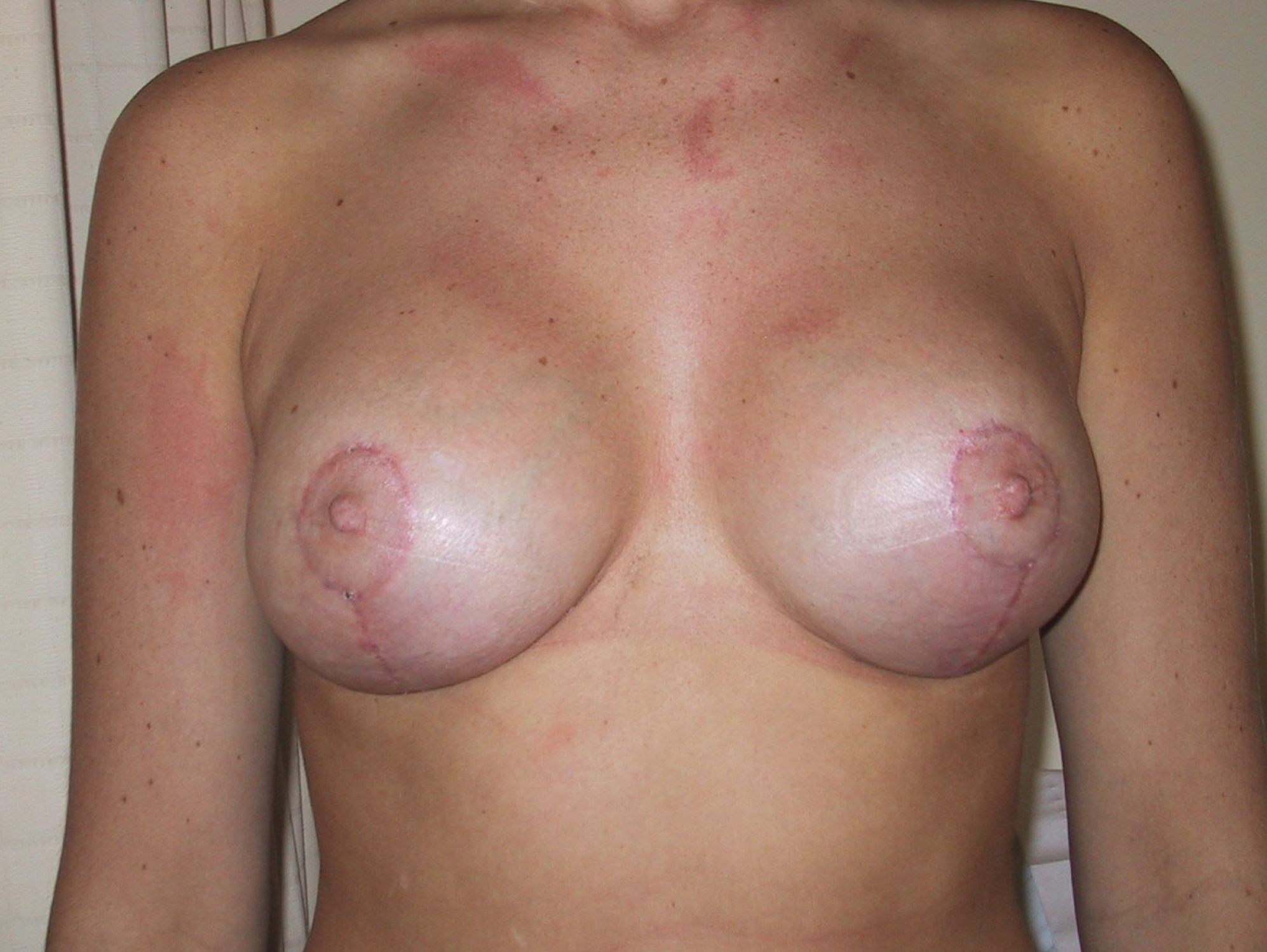 Breast Lift After Result 2
