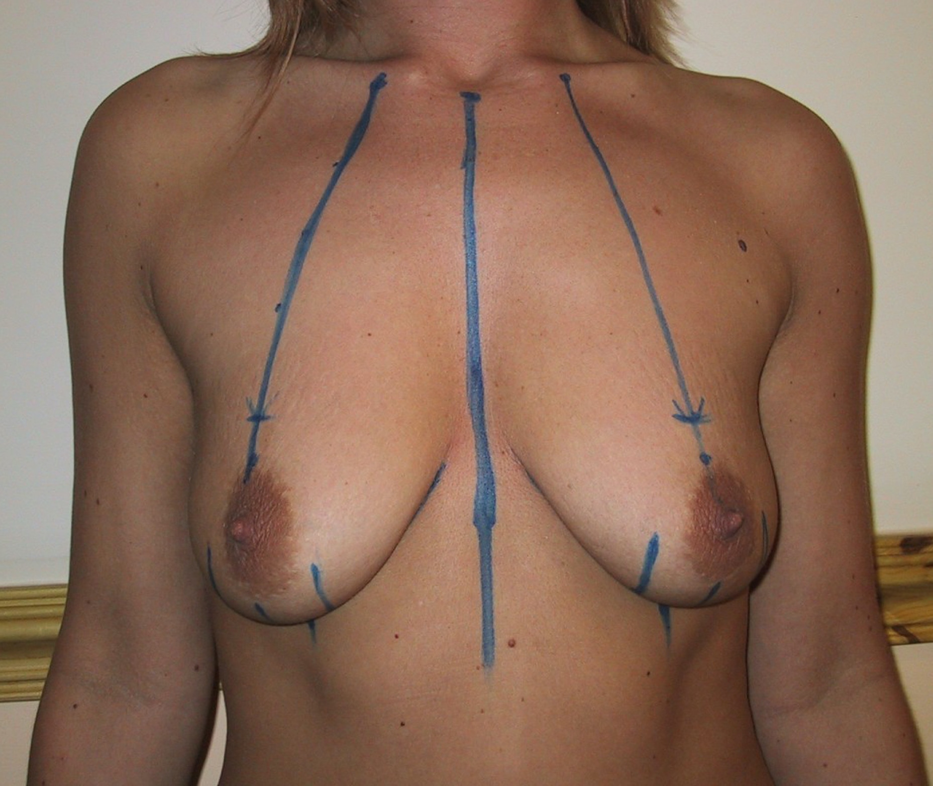 Breast Lift Before Result 8