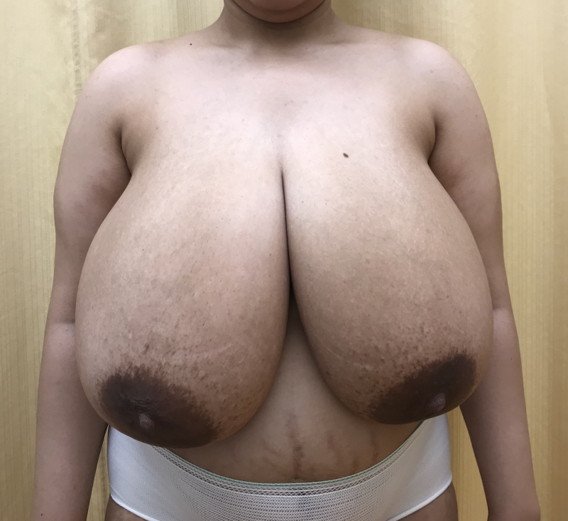 Breast Reduction Before Result 5