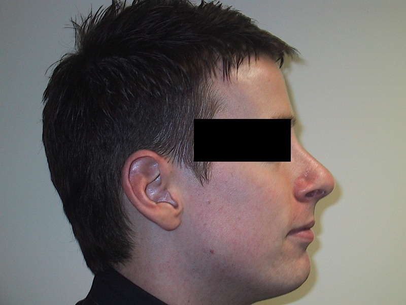 Rhinoplasty After Result 1