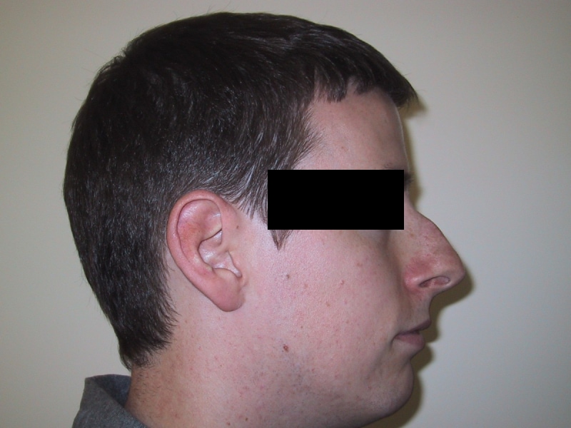Rhinoplasty Before Result 1