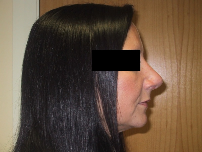 Rhinoplasty After Result 2