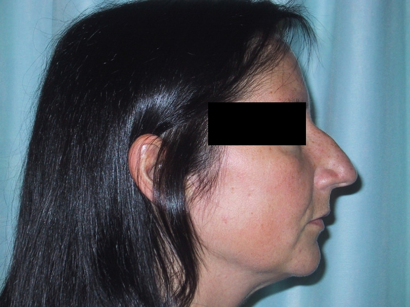 Rhinoplasty Before Result 2