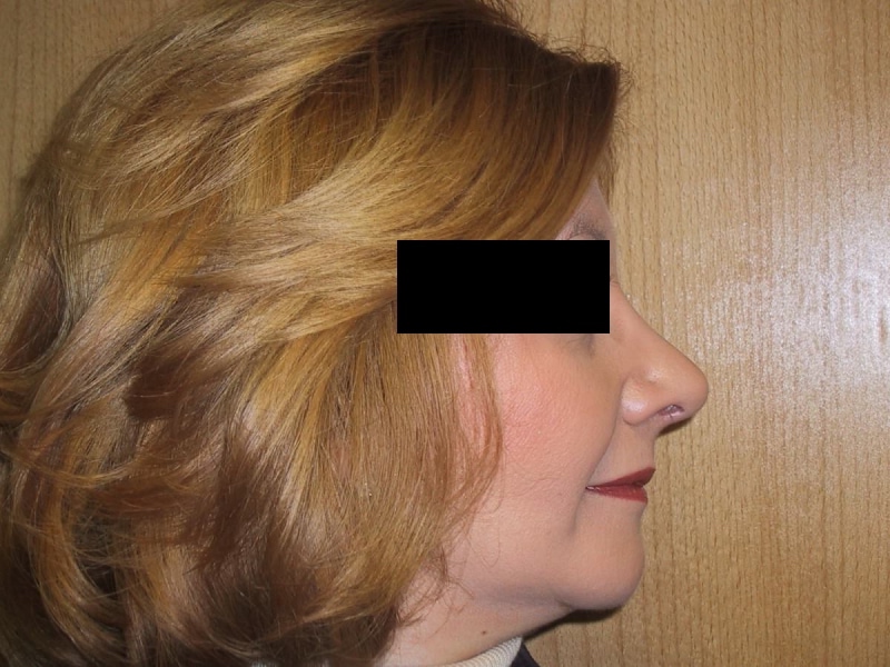 Rhinoplasty After Result 3