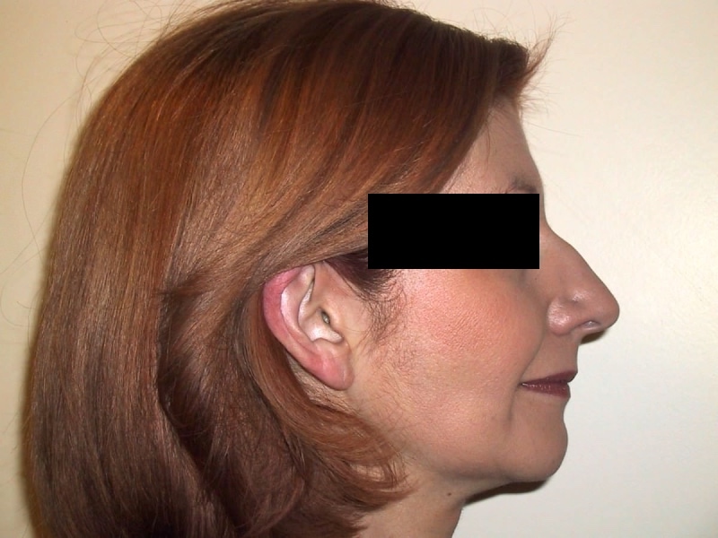 Rhinoplasty Before Result 3
