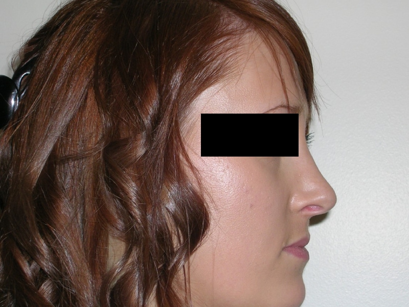 Rhinoplasty After Result 4