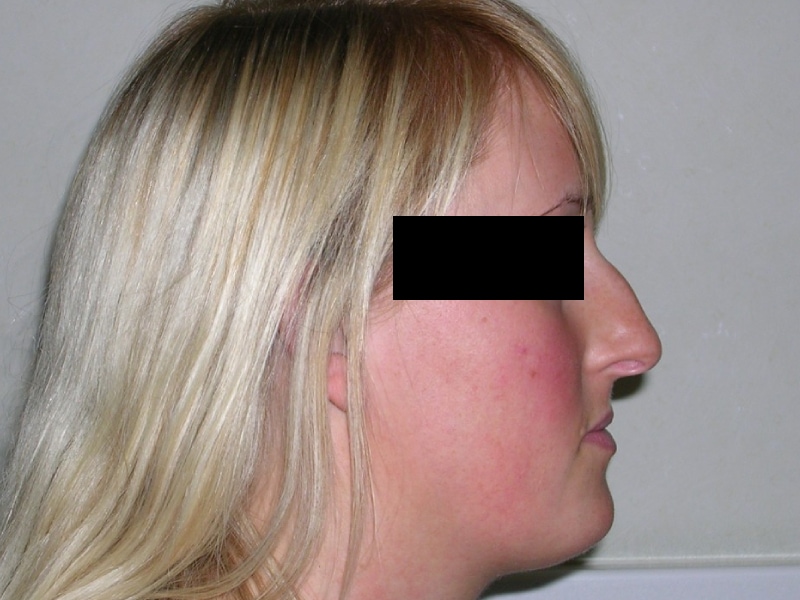 Rhinoplasty Before Result 4