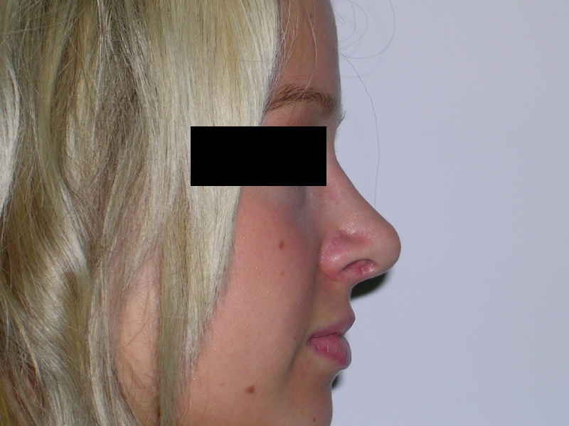 Rhinoplasty After Result 5