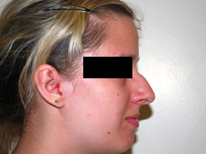 Rhinoplasty Before Result 5