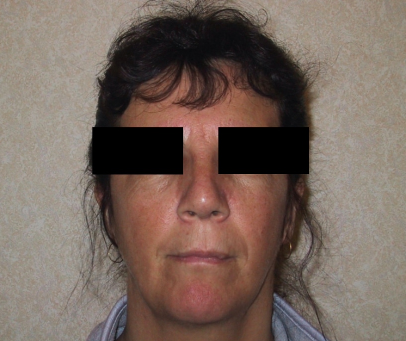 Rhinoplasty After Result 6