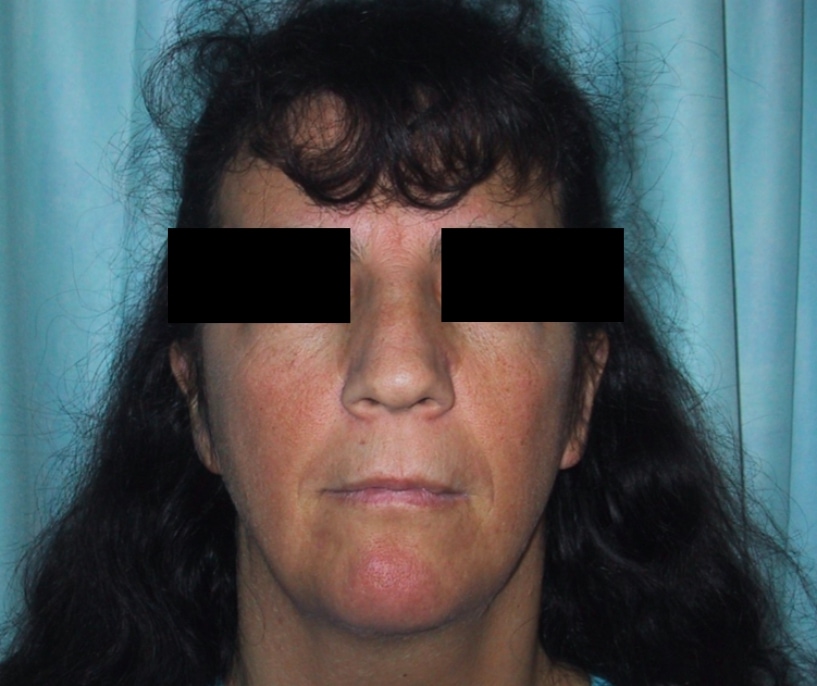 Rhinoplasty Before Result 6