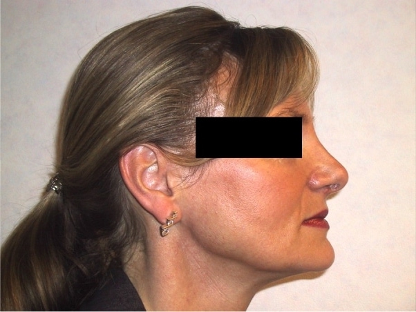 Rhinoplasty After Result 7