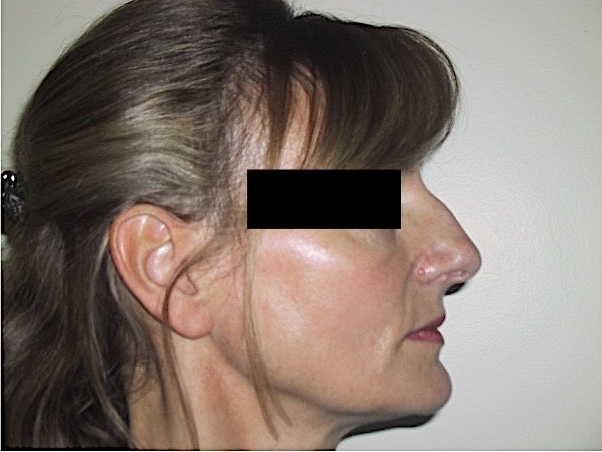 Rhinoplasty Before Result 7